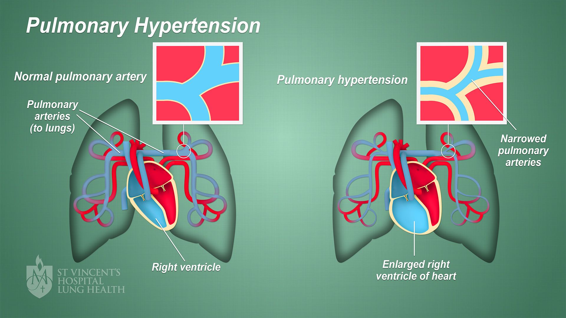 Pulmonary Hypertension